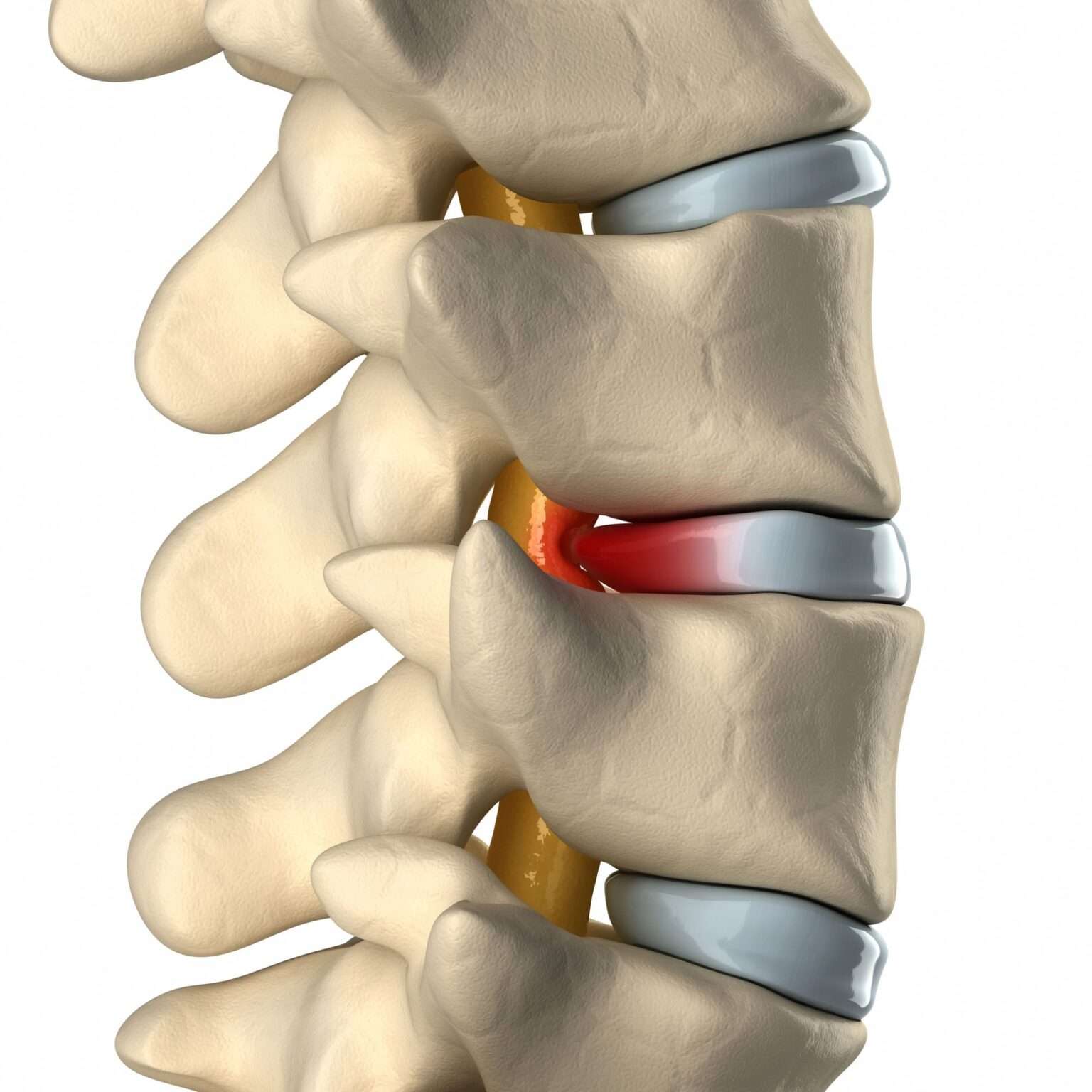 disc-prolapse